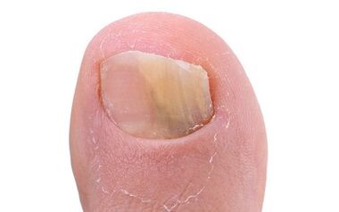 Symptoms of the presence of mushrooms on the thumb of the leg