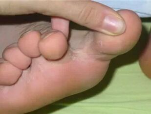 Itching of the fingers of the feet