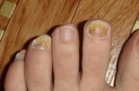 yellowing of the nail due to fungi
