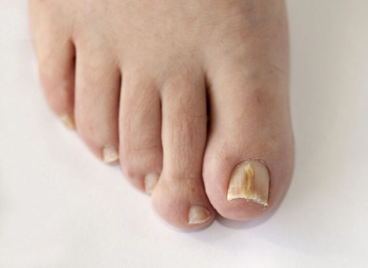 Toenail plaque affected by fungus