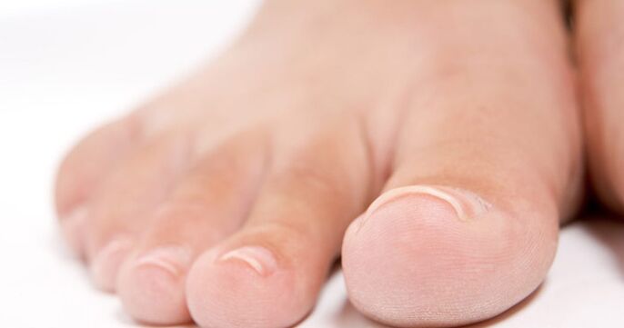 Toenails can be affected by a fungal infection