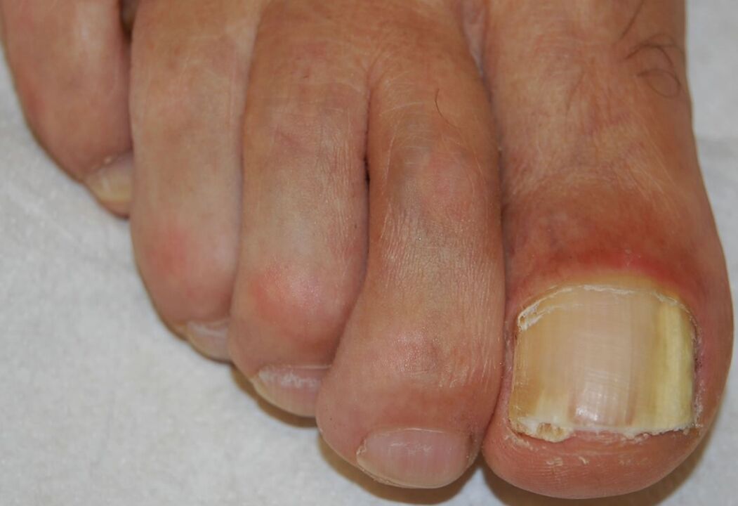 Distal-lateral subungual onychomycosis of the leg